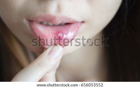 Woman with aphthae on lip. Royalty-Free Stock Photo #656053552