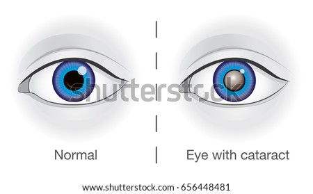Normal eye and lens clouded by cataract. Illustration about eyesight.