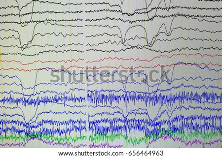 EEG wave in human brain,Abnormal EEG,Brain wave on electroencephalogram ,EEG wave background