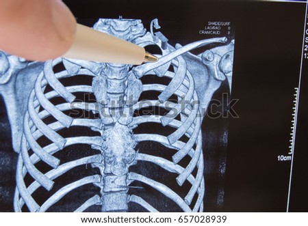 Doctor points out pen on clavicle in picture of 3D computer tomography. Anatomical location of collarbone and frequent destination of clavicle fracture with X-ray diagnostics in practice of trauma