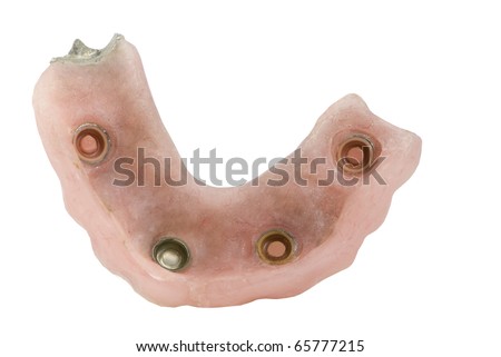 implant supported partial denture closeup