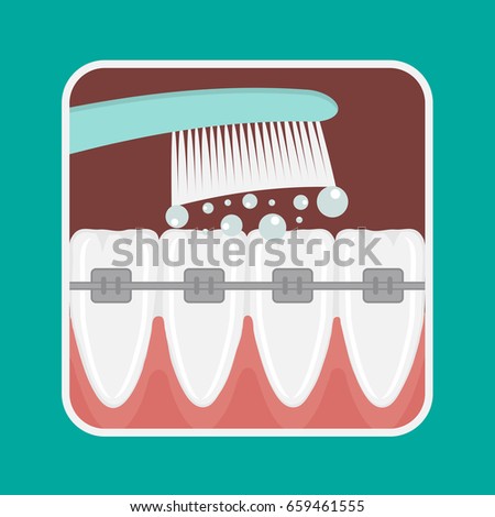 Vector illustration of teeth cleaning with braces. Toothbrush.
