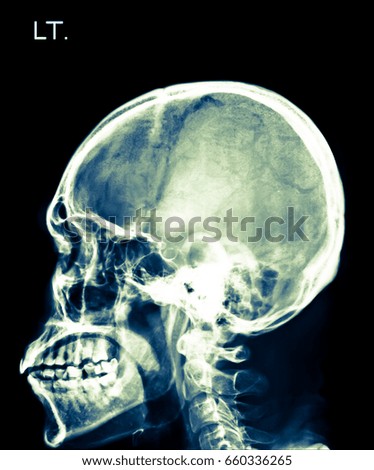 X-ray of head, skull in  left side
