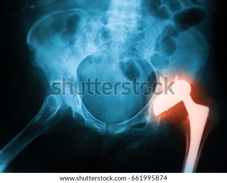 X-ray image of both hip, anteroposterior(AP) view,  showing dislocation of the total hip arthroplasty implant at left Royalty-Free Stock Photo #661995874