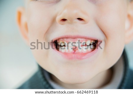 Childish cute mouth with beautiful lips and missing milk teeth dental health care and hygiene six years old toothless kid child closeup, horizontal picture