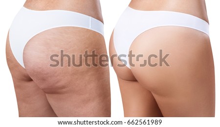 Female buttocks before and after treatment. Royalty-Free Stock Photo #662561989