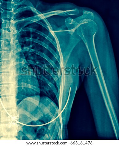 X-ray image of shoulder AP view.