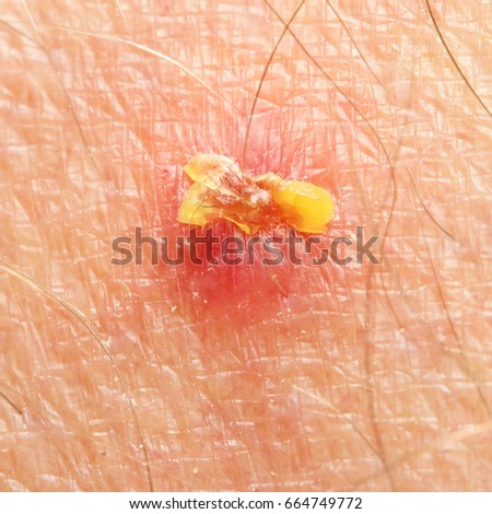 Bite mark, sting or sore on human skin. Close up of symptoms. Healthcare theme.