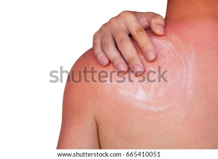 A man with reddened itchy skin after sunburn, smears cream on the skin. Skin care and protection from the sun's ultraviolet rays.