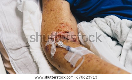 Patient in the hospital with saline intravenous on a elderly patient hand