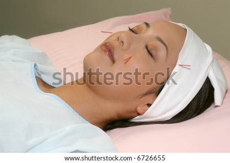pretty asian woman getting acupuncture