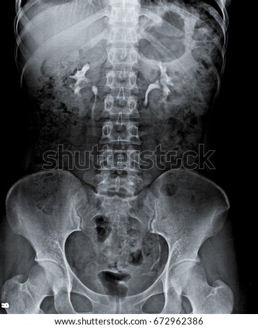 x ray of abdomen and contrast in kidney and ureter.