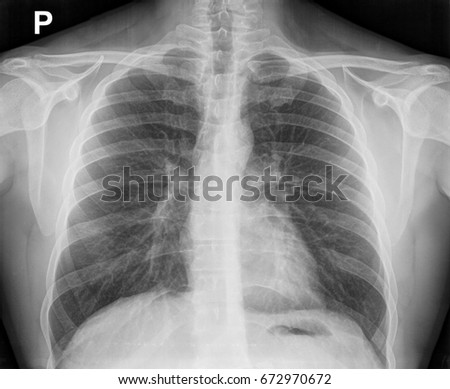X-ray image of the chest showing the internal anatomy of the rib cage, lungs and heart as well as the inferior thoracic border-made up of the diaphragm. Royalty-Free Stock Photo #672970672