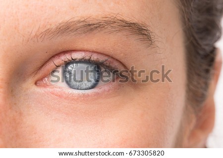 Eye of young girl with cataract Royalty-Free Stock Photo #673305820
