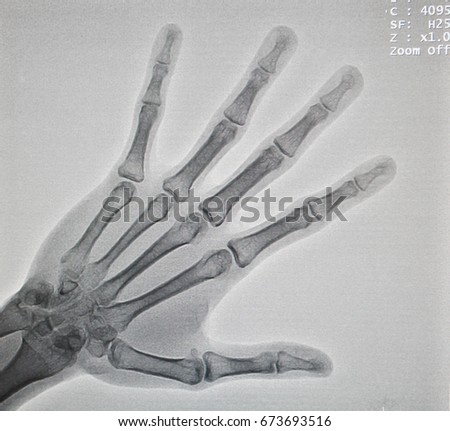 Photo of hand x-ray, it show all skeleton in hand