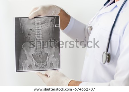 X-ray image of LS spine, AP view, show ankylosing spondylitis lumbar,Doctor examining a lung radiography, Doctor looking chest x-ray film,Anatomy.