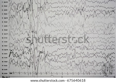 EEG wave in human brain,Abnormal EEG,Brain wave on electroencephalogram ,EEG wave background
