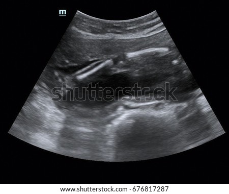 Ultrasound of baby in mother's womb.The images from a 2d ultrasound tend to be in black and white and have the same level of detail as a photographic 