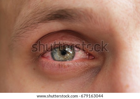 Red eye conjunctivitis Royalty-Free Stock Photo #679163044