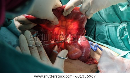 Resection of Small Bowels with Ligation of vessels during operation. Step by step surgery. Royalty-Free Stock Photo #681336967