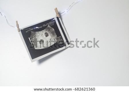 Twin pregnancy. An ultrasound picture of two babies.