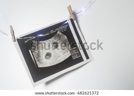 Twin pregnancy. An ultrasound picture of two babies.