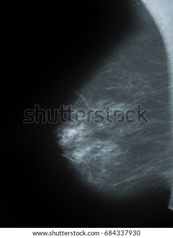 a Mammography picture - x-ray of Breast