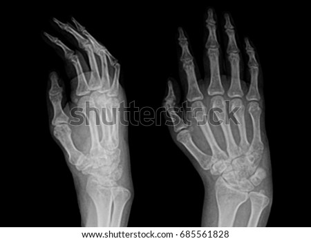 X-Ray Hand.         