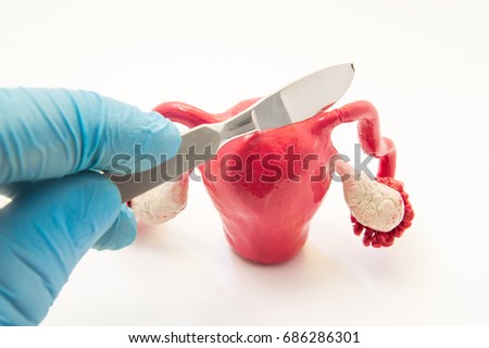Fallopian tube surgery for treat infertility or ectopic pregnancy photo concept. Doctor's hand with a scalpel is above the anatomical model of the uterus with fallopian tubes and ovaries Royalty-Free Stock Photo #686286301