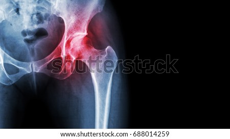 Arthritis at hip joint . Film x-ray show inflamed of hip joint and blank area at right side . Avascular necrosis concept . Royalty-Free Stock Photo #688014259