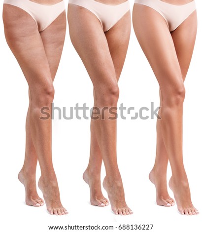 Woman legs before and after treatment.