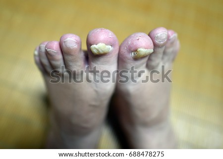 Athlete's foot and claw