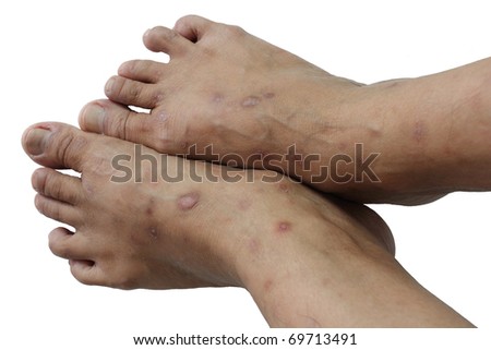 Psoriasis chronic non-contagious disease that affects mainly skin Royalty-Free Stock Photo #69713491