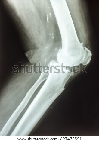 A side view at the stifle-joint, tibia and femur bone. Patient is a woman with age-related changes - osteoarthritis
