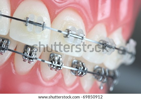 Denture with braces Royalty-Free Stock Photo #69850912