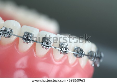 Denture with braces Royalty-Free Stock Photo #69850963