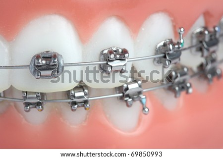 Denture with braces Royalty-Free Stock Photo #69850993