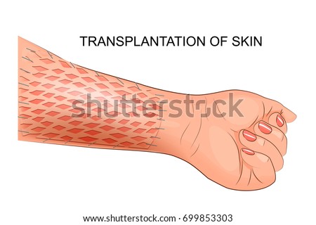 vector illustration of a skin graft. plastic surgery
 Royalty-Free Stock Photo #699853303