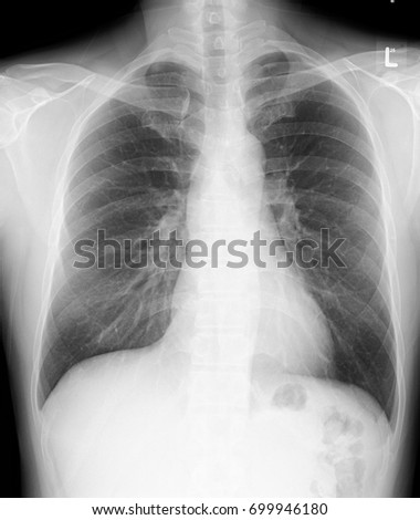 Film regular chest PA. Heart size, diaphragm and costophrenic sulci are normal, no pulmonary infiltration in both lungs, unremarkable bony thorax.