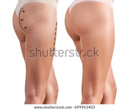 Woman's buttocks before and after plastic surgery