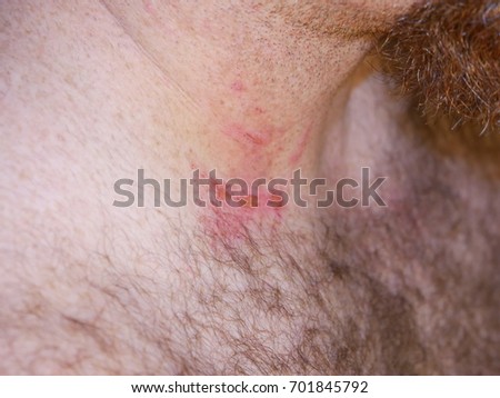 Picture Of Horse bite on Man's Neck