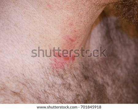 Picture Of Horse Bite