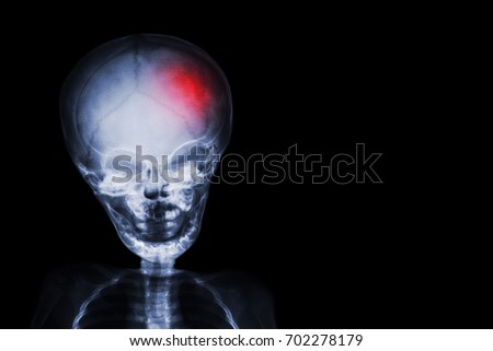 Stroke . film x-ray skull and body of child with red color at head . Neurological concept . Royalty-Free Stock Photo #702278179