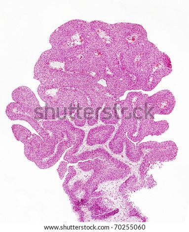 Microscope picture of bladder tumour