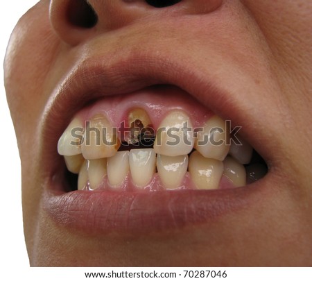 Broken tooth upper right central incisor frontal view Royalty-Free Stock Photo #70287046