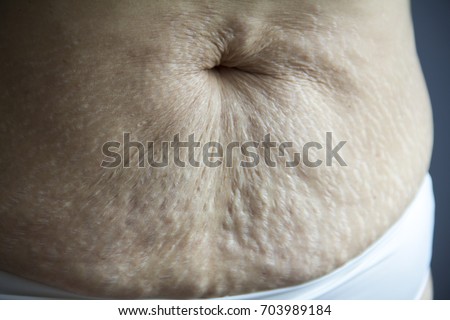 Picture of belly after giving birth,stretchmarks,belly button scar,wrinkle,pigmentation,pregnancy pouch and  a dark line down their abdomen.   
