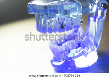 Dental teeth orthodontic dentistry teachng model with gums, tooth enamel, plaque, roots and metal implants.