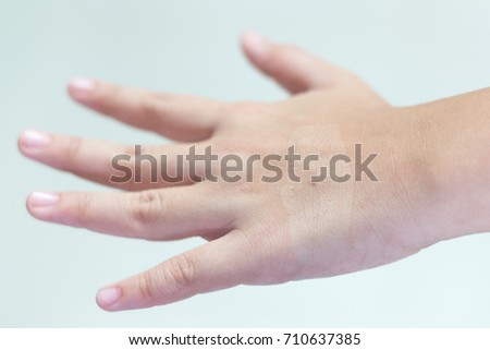 Hand of patient with wound from getting intravenous treatment IV after take adhesive plaster or bandage out
