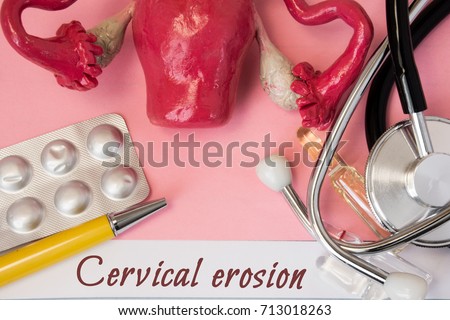 Diagnosis of Cervical Erosion. Medical history of patient with Diagnosis of Cervical Erosion inscription next stethoscope, uterus with ovaries figure, ampoule with medicine. Treatment and diagnostic