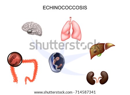 vector illustration of hydatid cyst of the brain, liver, lungs and kidneys. the causative agent Echinococcus

